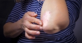 Psoriasis: Things to Know